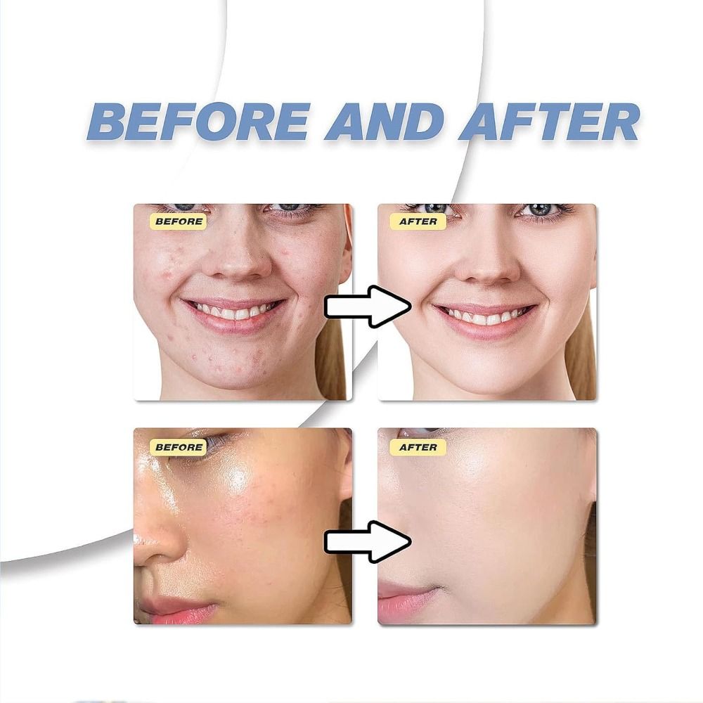 เซรั่มกรดอะซีเลอิก 12% 20% ครี - Azelaic Acid Serum บทวิจารณ์และราคา