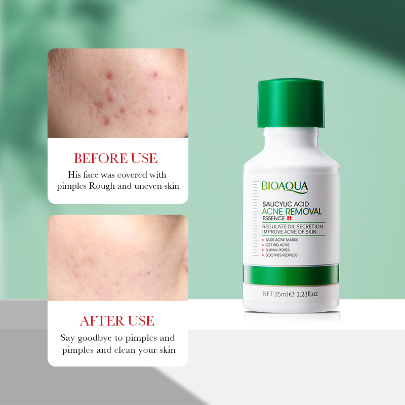 35ml BIOAOUA Salicylic Acid An - Azelaic Acid Serum บทวิจารณ์และราคา