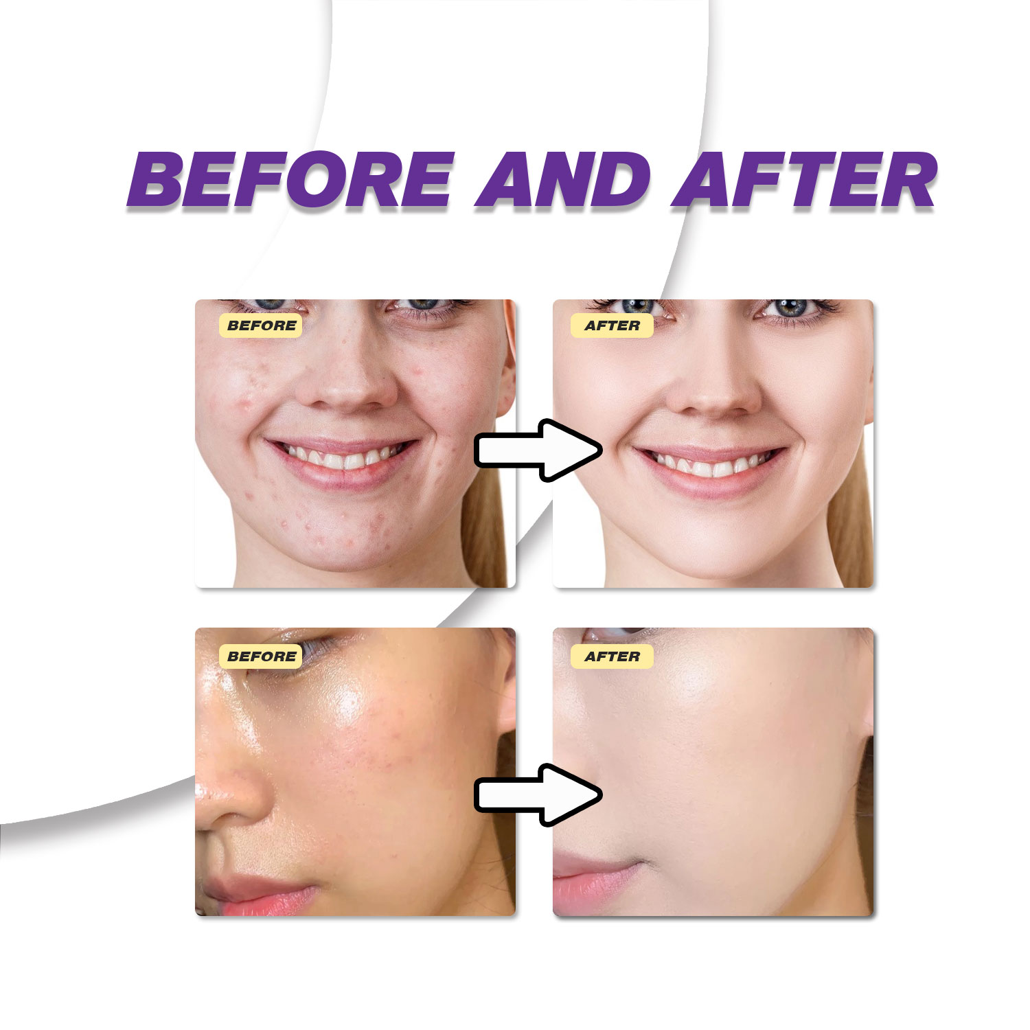 ครีมกรดอะซีเลอิกสูตรอ่อนโยน ช่ - Azelaic Acid Serum บทวิจารณ์และราคา