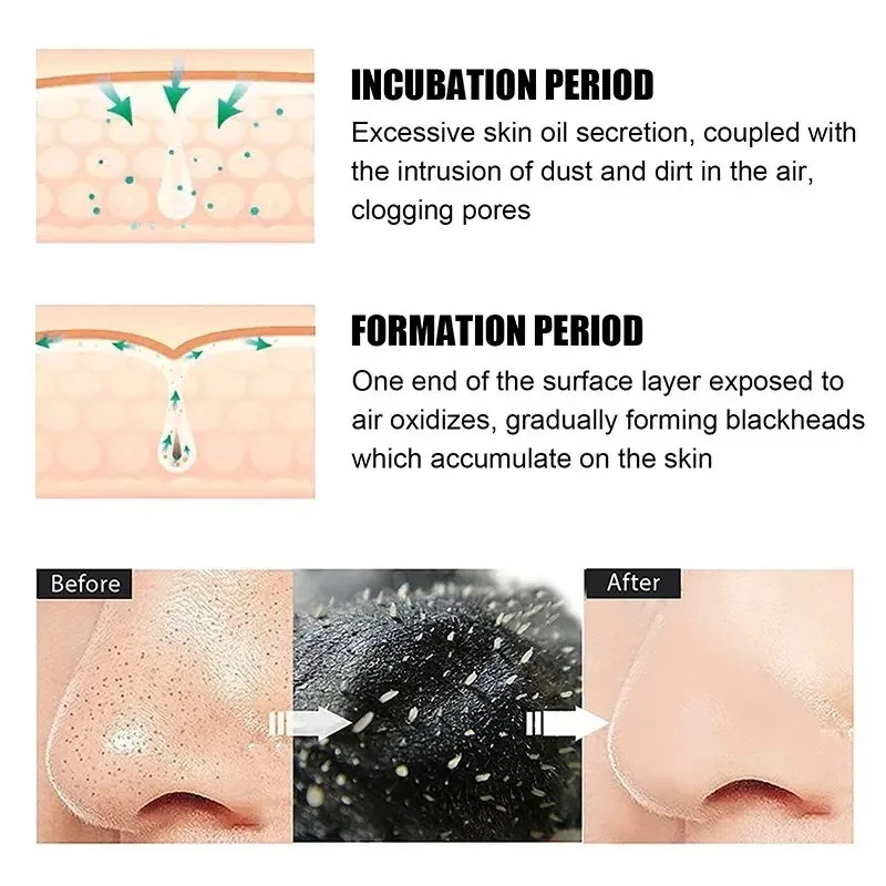 แผ่นมาส์กกำจัดสิวเสี้ยน 10/150 - Charcoal Pore Strip บทวิจารณ์และราคา
